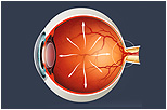 Glaucoma