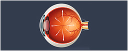 Glaucoma