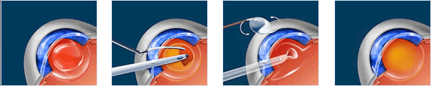 Cataract Surgery