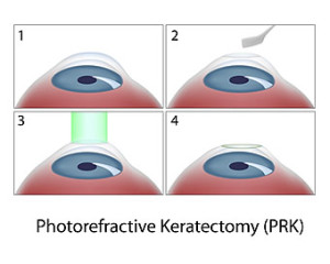 PRK Surgery Procedure Diagram