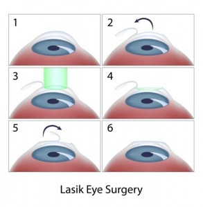 LASIK Eye Surgery Manhattan LASIK Eye Surgery Procedure