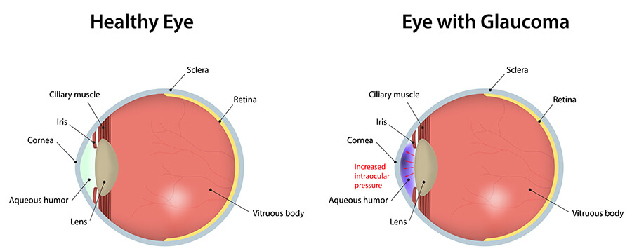 Chart showing healthy eye vs one with glaucoma