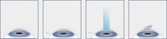 LASIK Eye Surgery Manhattan LASIK Eye Surgery Procedure Diagram