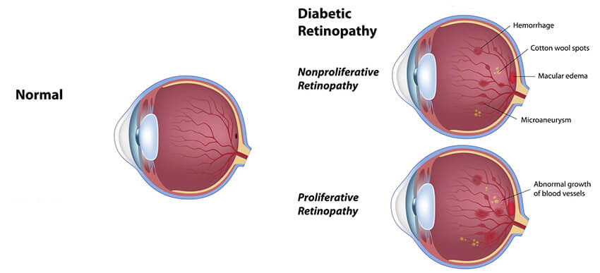 Chart Showing a Normal Eye Compared to One with Diabetic Retinopathy