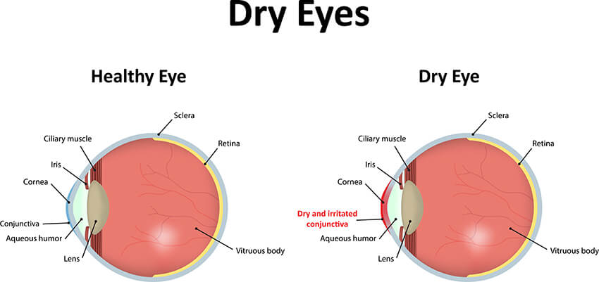 Chart showing a healthy eye compared to one with dry eyes
