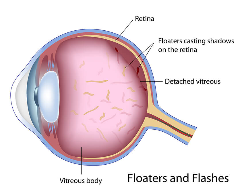 Eye Floater Diagram