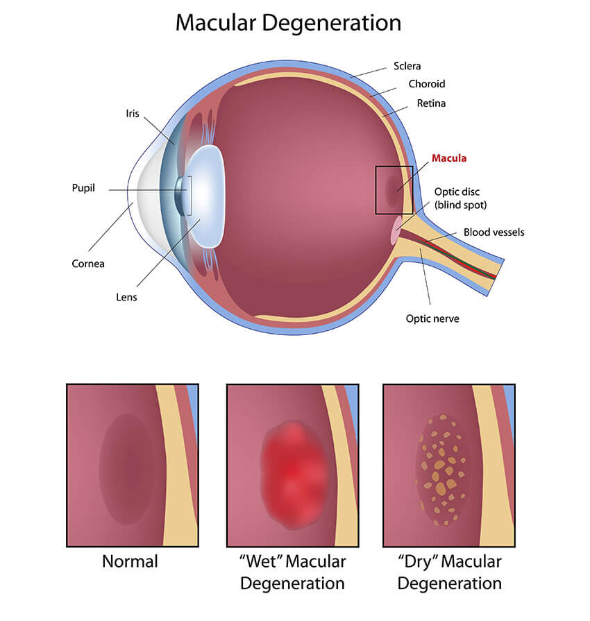 Chart Showing an Eye With Macular Degeneration