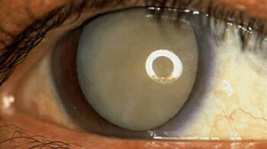Closeup of an eye with a mature cataract