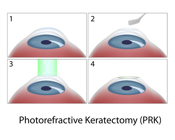 PRK Surgery Procedure Diagram