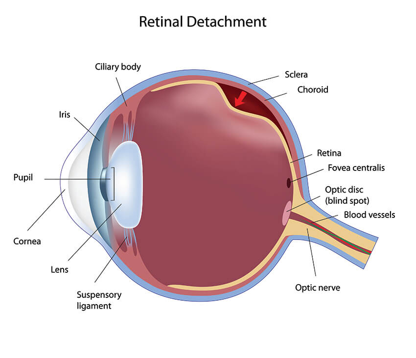 Retinal Detachment Diagram