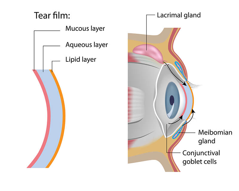 Chart Showing Tear Film in a Dry Eye