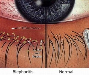 Blepharitis Diagram